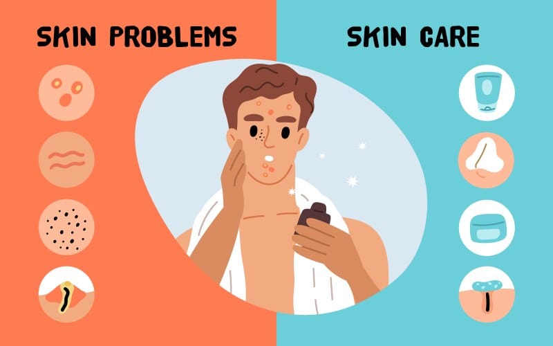 How To Clear Acne Naturally