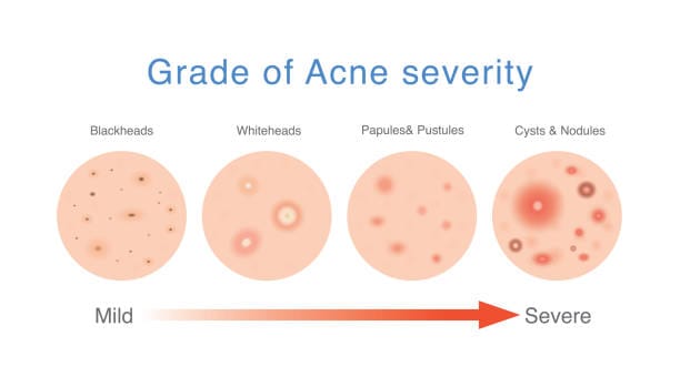 How To Treat Cystic Acne