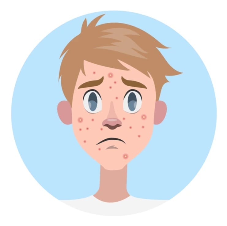 How To Prevent Acne Breakouts